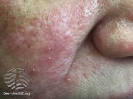 Image result for Sebaceous Gland