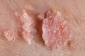 Care Sunt Pericolele Virusului Papiloma La Femei Eroziune Hpv È™i Cancer De Col Uterin Despre Papilomavirus Uman