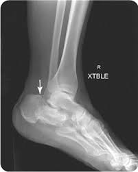 Image result for Calcaneus Compression Fracture