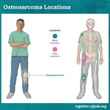 Image result for Osteosarcoma