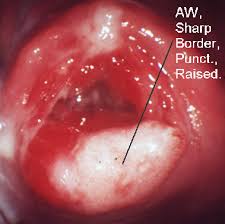 Image result for Colposcopy Findings