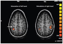 Image result for Conversion Disorder