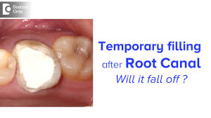 If cost is stopping you from seeing the dentist when a root canal is needed, ask them about a payment plan. How Long Can You Keep A Temporary Filling After Root Canal Dr Chandan Mahesh Youtube
