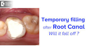 There are many reasons your jaw could hurt that do not require a root canal. How Long Can You Keep A Temporary Filling After Root Canal Dr Chandan Mahesh Youtube