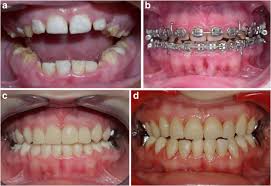Amelogenesis Imperfecta Therapeutic Strategy From Primary To Permanent Dentition Across Case Reports Bmc Oral Health Full Text