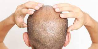 You don't want to waste your time a naturally occurring mineral, silica is one of the building blocks that the body uses to produce. 5 Best Silica Supplements For Hair Loss Growth 2018