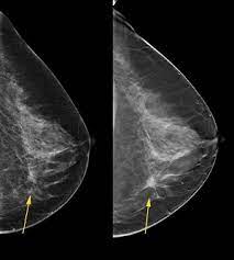 Rate of dcis discovery is increasing, due to screening mammograms. Benefits Of 3 D Mammograms Last Over Time