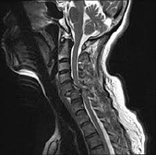Image result for Spinal Trauma