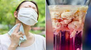 La enfermedad del virus de marburgo comienza de súbito con fuerte fiebre, e intensos dolores de cabeza. Fqemh Bc8iezwm