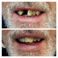 ✨ Before ➡️ After ✨ Dr Matthew transformed this smile with an  implant-retained bridge! Confident, natural, and ready to shine 💙🦷  #SmileTransformation #DentalImplants #BeforeAndAfter #LymeBayDental  #Anthogyr #fullyguidedimplants #matt_the_dentist