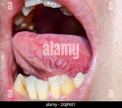 Image result for Sublingual Varices