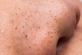 The area around the infected ingrown hair may. Why You Should Never Pop Zits Ingrown Hairs And Other Bumps Men S Health