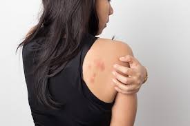 Image result for sweat rash on back