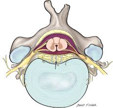 Ligament, tough fibrous band of connective tissue that serves to support the internal organs and hold bones together in proper articulation at the joints. Cureus The Epidural Ligaments Of Hofmann A Comprehensive Review Of The Literature