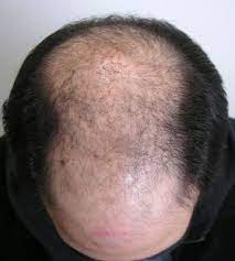 Hair loss, known as alopecia, can have several causes, including metabolic and nutritional disorders.certain causes may be accompanied by itching or burning. Causes Of Hair Loss Manhattan Nyc True Dorin Medical Group Hair Restoration