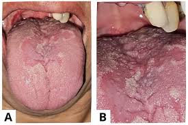 Image result for Fissured tongue