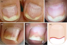 Image result for Onycholysis feet