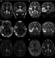 Severe infection, particularly untreated herpes simplex virus (hsv) encephalitis, can cause brain hemorrhagic necrosis. Herpes Simplex Virus Induced Anti N Methyl D Aspartate Receptor Encephalitis A Systematic Literature Review With Analysis Of 43 Cases Nosadini 2017 Developmental Medicine Amp Child Neurology Wiley Online Library