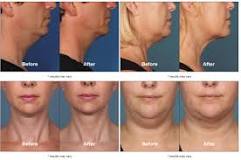 Image result for how much does the kybella treatment cost