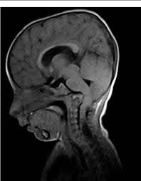 The congenital mirror movements begin in infancy and persist throughout the patient's life, often joubert syndrome is a rare autosomal recessive genetic disorder that affects the cerebellum, an area. Figure 2 From Seckel Syndrome With Asymptomatic Tonsillar Herniation And Congenital Mirror Movements Semantic Scholar