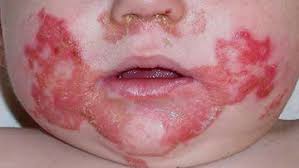 Image result for Zinc Deficiency