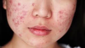 Untuk menghilangkan bopeng bekas jerawat dengan witch hazel, anda hanya perlu mengoleskan gel bahan alami ini pada kulit wajah. Cara Menghilangkan Bekas Jerawat Merah Ini Terbukti Manjur Mau Coba Kumparan Com