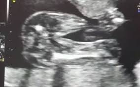 Ultraschallbild Madchen Oder Junge Schwanger Wer Noch