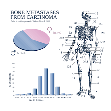 Your treatment team can tell you more about your individual risk of recurrence if you want to know this. Metastatic Breast Cancer Bonetumor Org