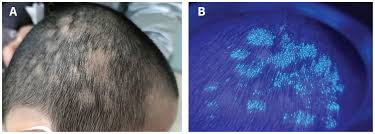 Image result for Tinea Capitis