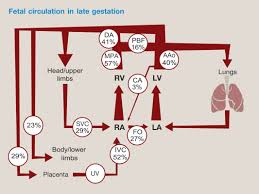 Image result for Delayed Transition from Fetal Circulation