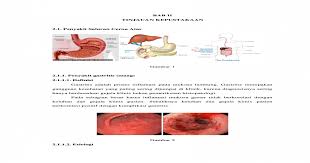 Gastritis merupakan panyakit karena gangguan ? Peran Kunyit Dalam Penyakit Saluran Cerna Atas Docx Document