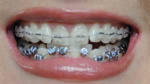 #howto #braces #paracetamol #diy #stayhome #withmetoday i am going to share some home remedies for controlling braces pain.hope it will be useful to you in. Braces Pain And Homeopathy