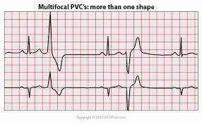 Ceufast Com Multifocal Pvc Ecg Interpretation Ekg Ekg Interpretation