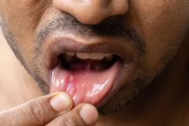 Image result for Canker sores roof of mouth