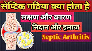 सेप्टिक गठिया क्या होता है, लक्षण, कारण और इलाज || Septic arthritis in  Hindi || MedHealth Support - YouTube