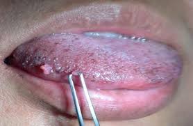 Image result for papillomavirus tongue)