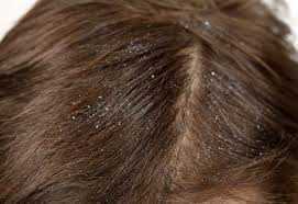 Image result for lice vs dandruff