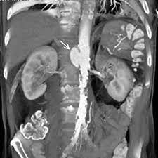 El síntoma más común es un dolor constante, opresivo, localizado en mesogastrio, hipogastrio o en la región lumbar, imitando el dolor radicular (los movimientos no influyen en la intensidad del dolor; Abdominelle Aortale Aneurysmen Aaa Herz Kreislauf Krankheiten Msd Manual Profi Ausgabe