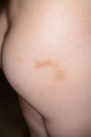 Image result for Urticaria pigmentosa children