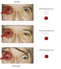 Image result for Diplopia