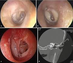 Image result for Myringosclerosis