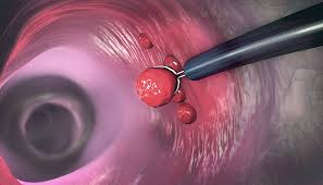The rates of colon cancer in people younger than 50 have been increasing, but doctors aren't sure why. Do Colon Polyps Mean I Have Cancer Moffitt