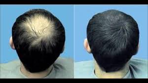 Although the test prop doesn't present overly strong estrogenic side effects, it does provide some very potent androgenic side effects because it is converted into a bigger and much stronger dht androgen. Micro Needling Hair Loss Treatment à¤¹ à¤¯à¤° à¤² à¤¸ à¤Ÿ à¤° à¤Ÿà¤® à¤Ÿ à¤¸à¤° à¤µ à¤¸ à¤œ à¤¹ à¤¯à¤° à¤² à¤¸ à¤¸ à¤Ÿ à¤° à¤Ÿà¤® à¤Ÿ à¤¸à¤° à¤µ à¤¸ à¤¹ à¤¯à¤° à¤² à¤¸ à¤¸ à¤‰à¤ªà¤š à¤° à¤• à¤¸ à¤µ à¤ In Bengaluru Sparha Advanced Wellness Studio Id 20358940633