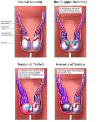 If testicular cancer has spread to other parts of your body, you may also experience other symptoms. Testicular Torsion Healthdirect
