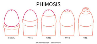 Image result for paraphimosis