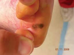 How does a melanoma look like? What You Should Know About Malignant Melanoma Podiatry Today