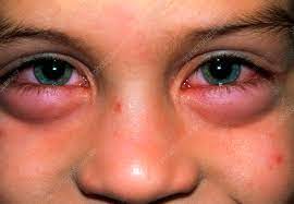 Child With Swollen Eyes From An Allergic Reaction Stock Image M320 0240 Science Photo Library