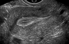 Ultrasound in the quantification of female pelvic organ prolapse. Pin On Female Pelvic