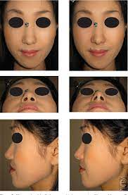 The anterior nasal spine, or anterior nasal spine of maxilla, is a bony projection in the skull that serves as a cephalometric landmark. Pdf Westernization Of The Asian Nose By Augmentation Of The Retropositioned Anterior Nasal Spine With An Injectable Filler Semantic Scholar