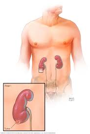 Metastatic spread is what makes cancer a deadly disease. Kidney Cancer Diagnosis And Treatment Mayo Clinic